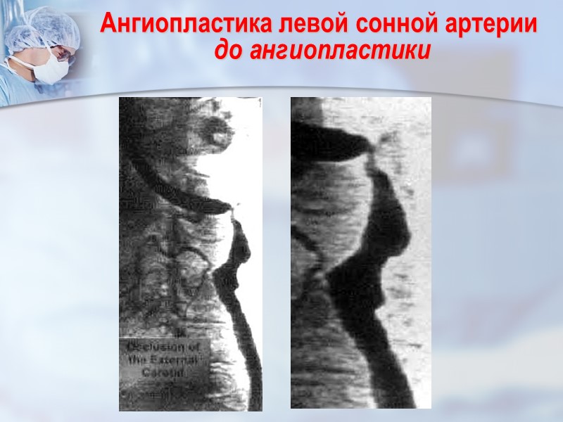 Ангиопластика левой сонной артерии  до ангиопластики